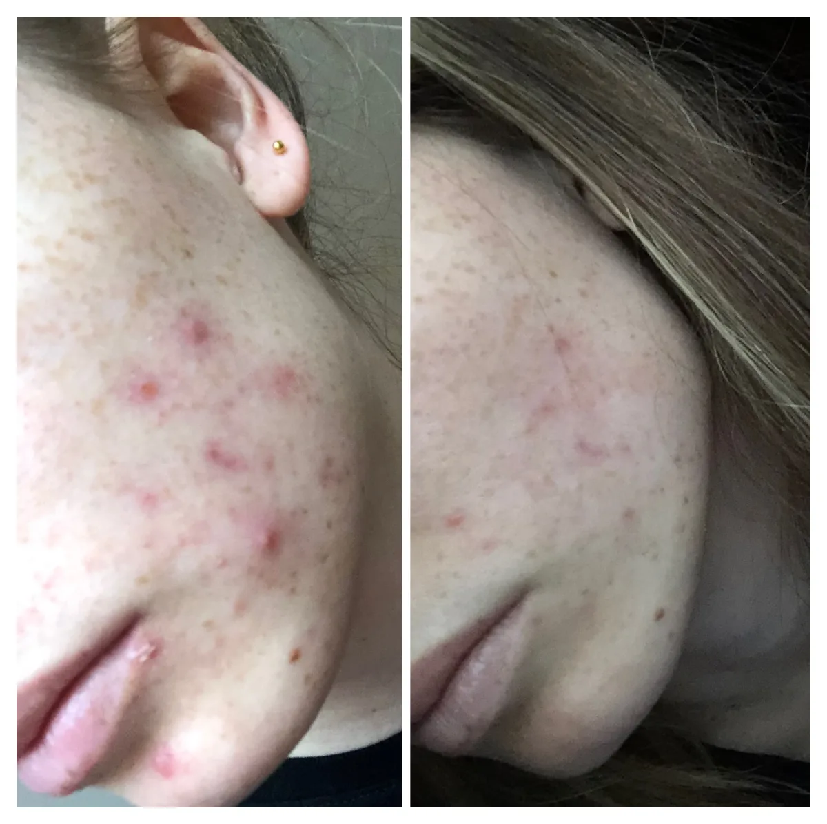 Skin Accumax - review image