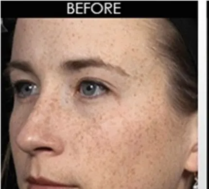 Azelaic Acid Serum - before review image