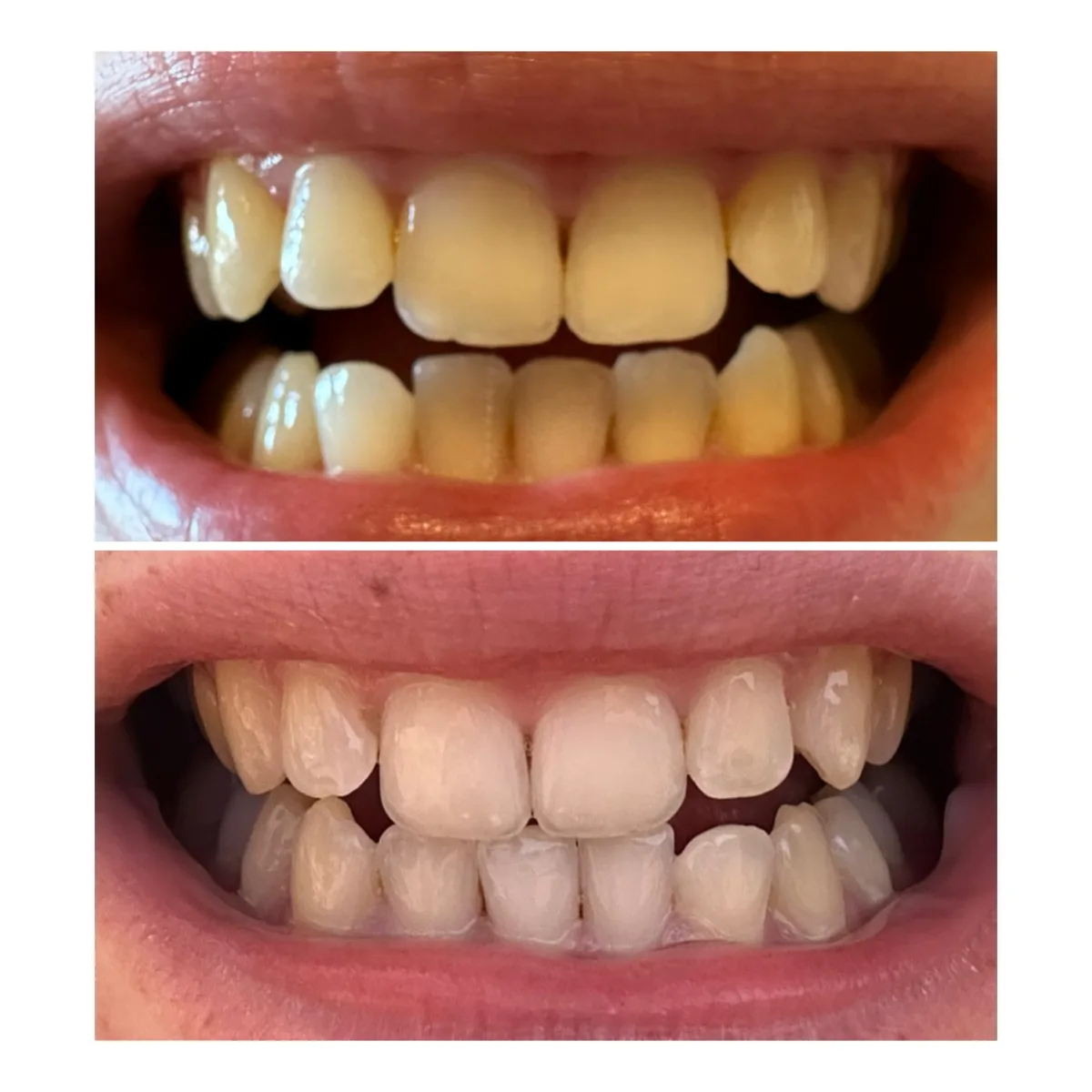 Teeth Whitening Strips - review image