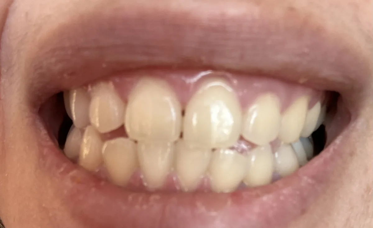 Day Teeth Whitening Kit - before review image