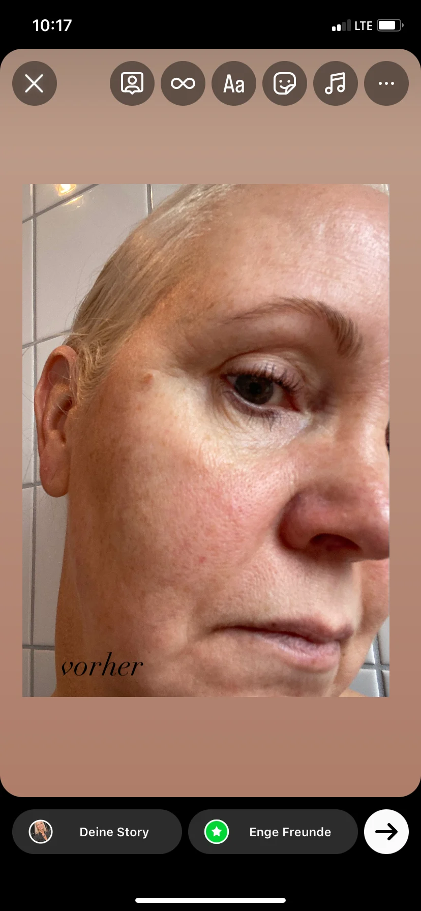 Azelaic Acid Serum - before review image