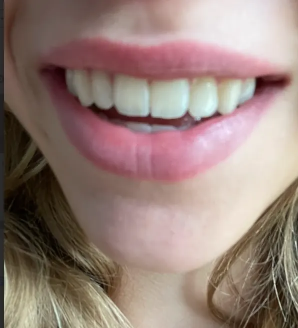 Vaseline lip care - rosy lips  therapie - lip balsem 7 g - handig pocket potje - afsluitbaar 3 x 1.5 cm - lippenbalsem -l - before review image