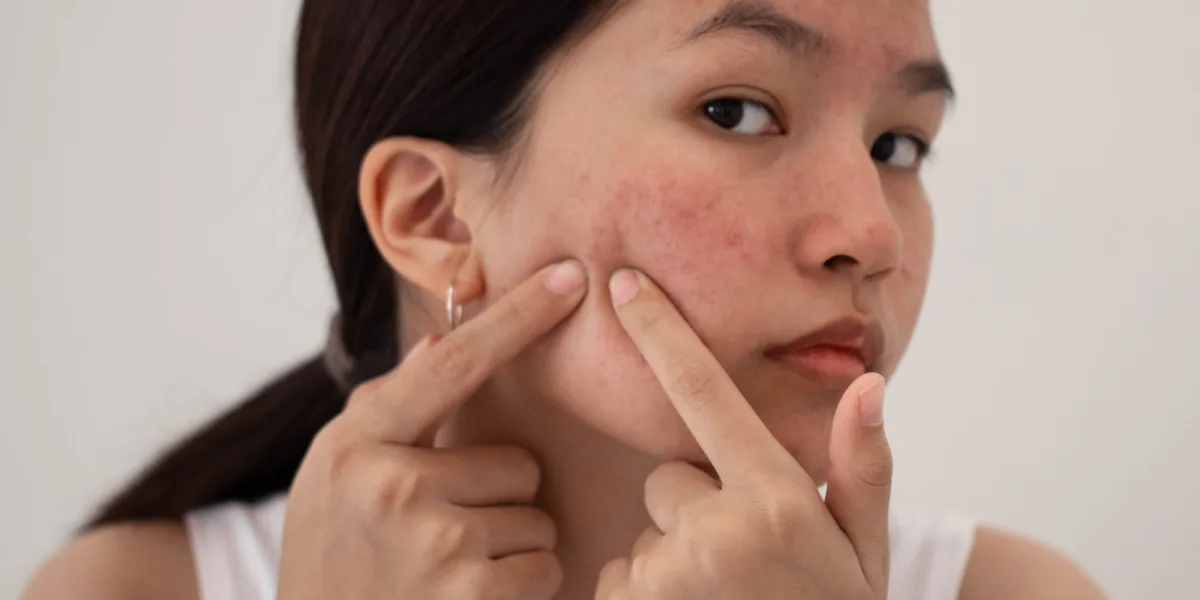 Een acne huid? Eves-members zweren bij deze producten 