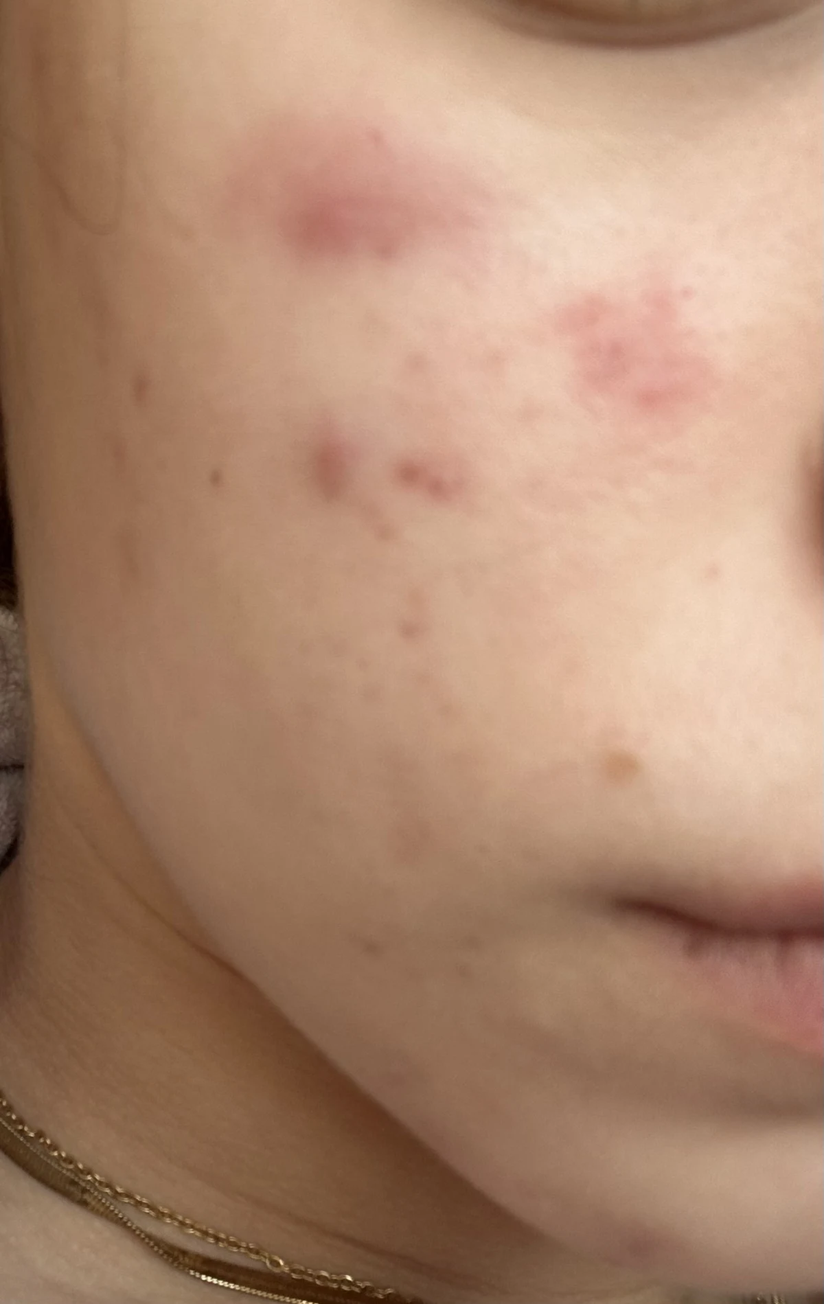 AHA BHA PHA 30 Days Miracle Toner - before review image