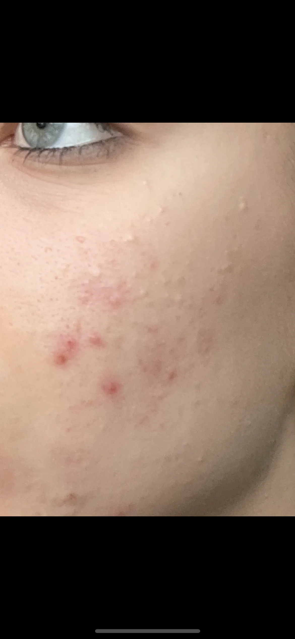 CeraVe Blemish Control Face Cleanser with 2% Salicylic Acid & Niacinamide for Blemish-Prone Skin 236ml - before review image