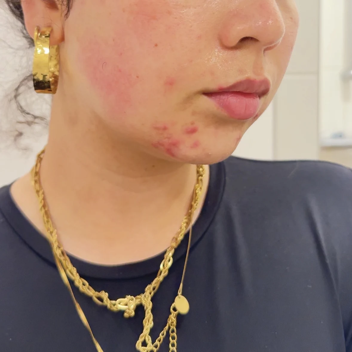 The Ordinary Salicylic Acid 2% Anhydrous Solution - before review image