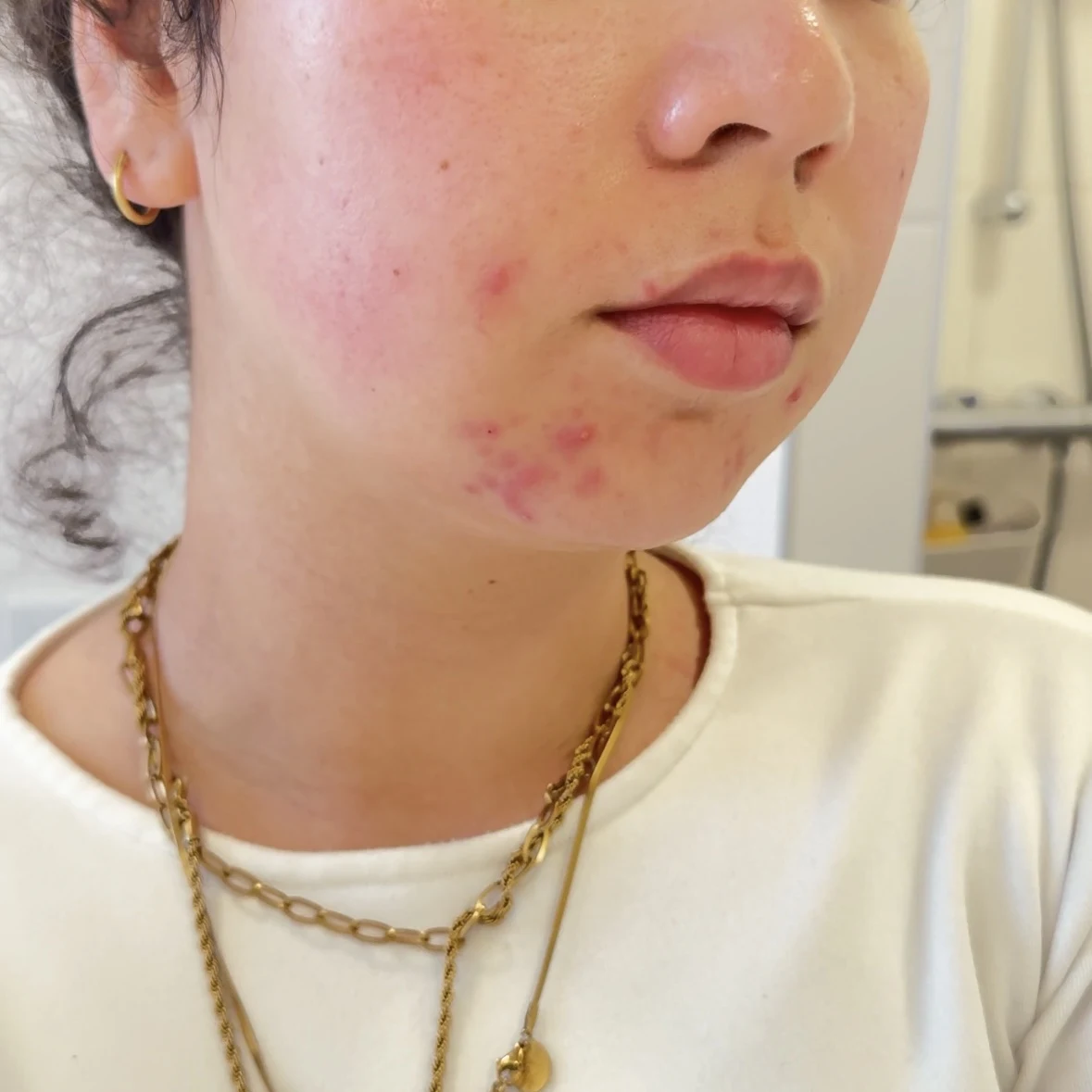 The Ordinary Salicylic Acid 2% Anhydrous Solution - review image